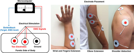 A photograph showing the placement of electrodes on the hand and arm.