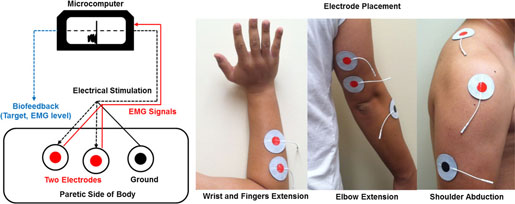 Neuromuscular Stimulation A photograph showing the placement of electrodes on the hand and arm.