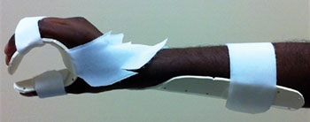 A photograph of a splint used for hand positioning.