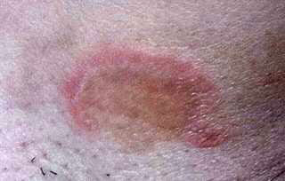 Tinea corporals (ringworm)