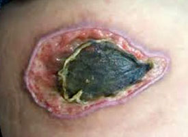 Photo of Wound Showing Black Eschar