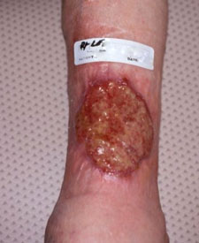 Photo of Venous Leg Ulcer